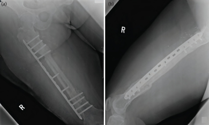 Chimeric Free Fibula Osteocutaneus Flap and Massive Allograft for Refractory Post-traumatic Osteomyelitis Femur Defect: A Case Report.
