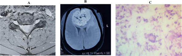 A retrospective single-centre study on the histological profile of brain and spine tumours at a tertiary hospital in Ghana.
