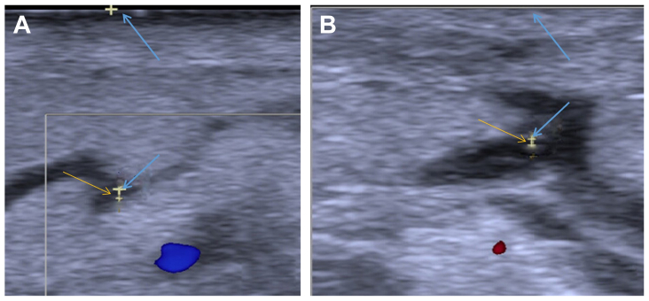 Efficacy study of lymphaticovenular anastomosis via the lymphosome-based four-incision approach for lower limb lymphedema
