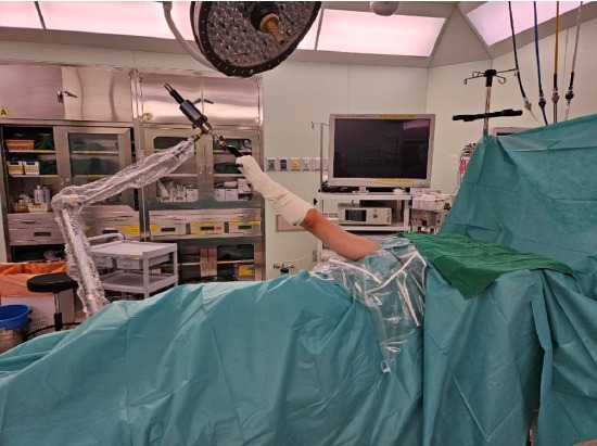 Rare complication of acute transient parotitis after arthroscopic rotator cuff repair: a case report.