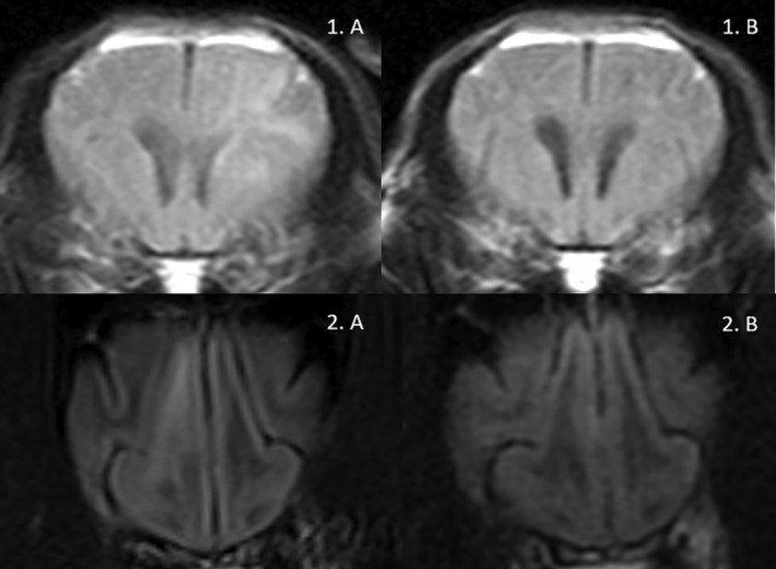 Peritumoral Edema in Canine Extra-Axial Brain Tumours: Effect of Steroids.