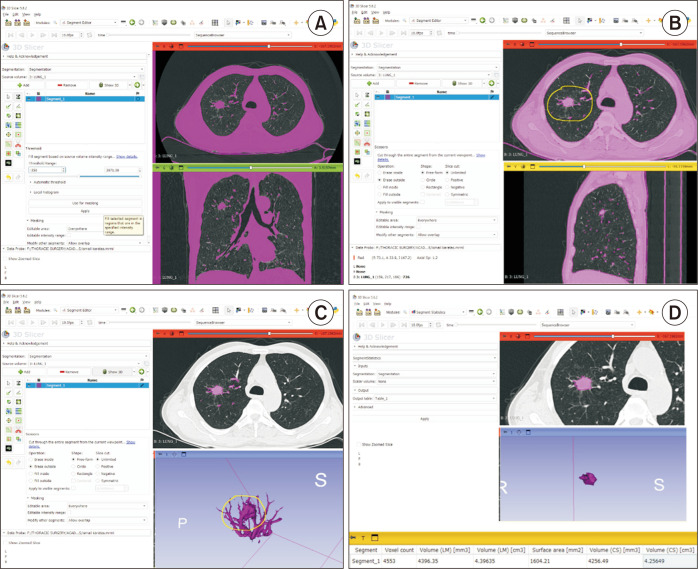 Recommendation for Clinical T Staging in Patients with Non-Small Cell Lung Cancer: Volumetric Measurement: A Retrospective Study from Turkey.