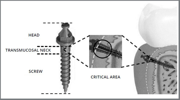 Comparative evaluation of orthodontic mini-implants hygiene protocols on subgingival bacterial load.
