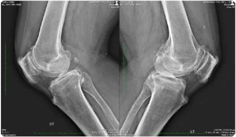 Diffuse Idiopathic Skeletal Hyperostosis, beyond the Axial Skeleton: Extra-spinal DISH.
