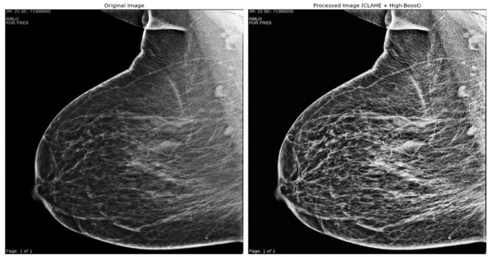 (KAUH-BCMD) dataset: advancing mammographic breast cancer classification with multi-fusion preprocessing and residual depth-wise network.