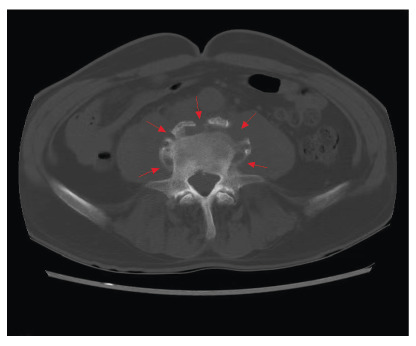 The appearances of a parrot's peak and petal rims in brucellar spondylitis.
