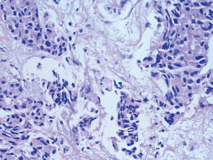 Sustained Remission With Atezolizumab in a Frail, Geriatric Patient With Advanced-Stage Large Cell Neuroendocrine Carcinoma Lung.