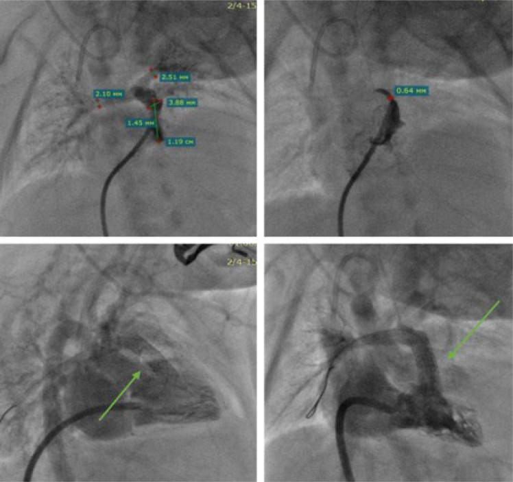 Comparative Study on the Outcomes of Right Ventricular Outflow Tract Stenting vs. Modified Blalock-Taussig Shunt in Patients with Tetralogy of Fallot: A Prospective Randomized Trial.