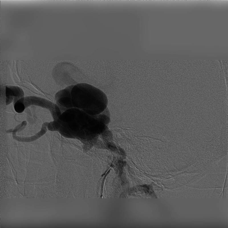 Echoes of Trauma: DSA-Guided Coil Embolization for Carotid Cavernous Fistula Presenting with Ocular Bruit and Pulsatile Exophthalmos.
