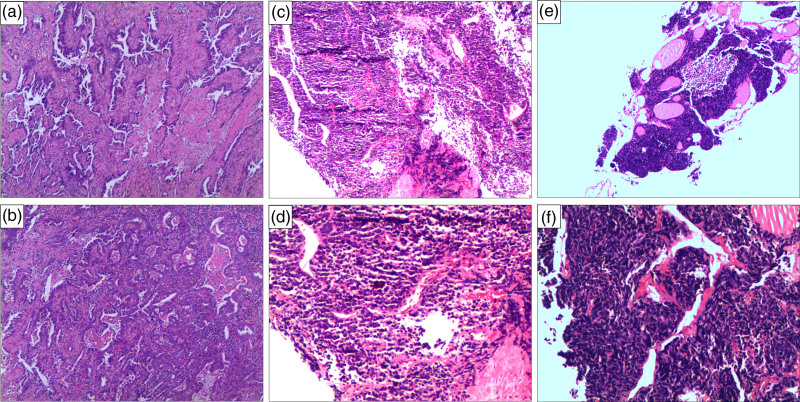 Transformation of lung adenocarcinoma to small cell lung cancer following osimertinib treatment: a case report and literature review.