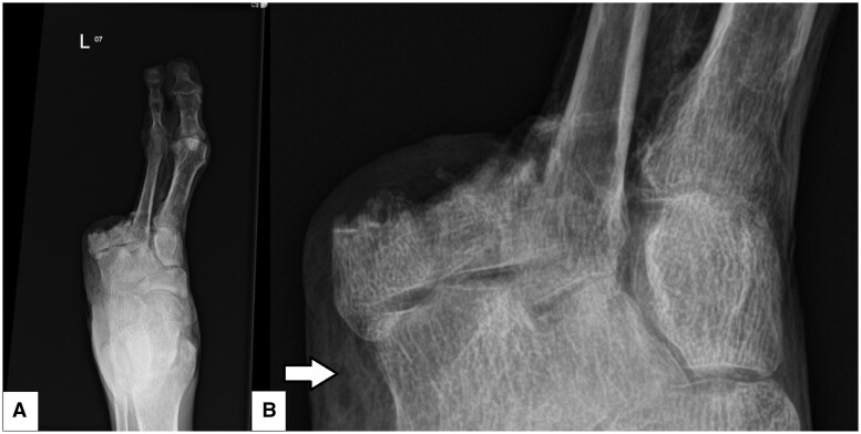 Soft tissue and intraosseous pneumatosis secondary to diabetic foot ulcer: a severe case of emphysematous osteomyelitis.