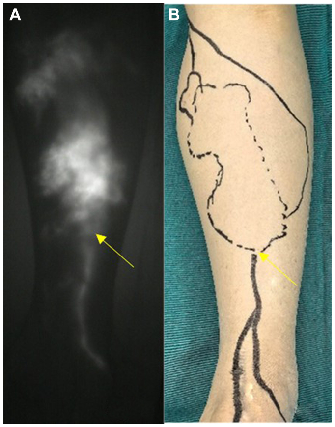 Efficacy study of lymphaticovenular anastomosis via the lymphosome-based four-incision approach for lower limb lymphedema