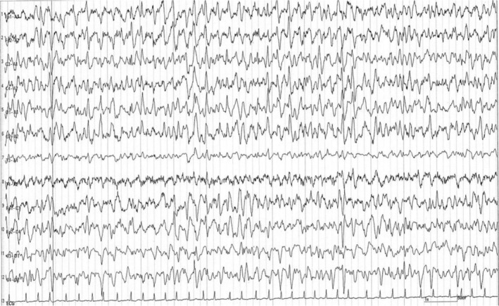 Development of cefepime-induced encephalopathy in a patient with depression and rectal cancer: A case report.