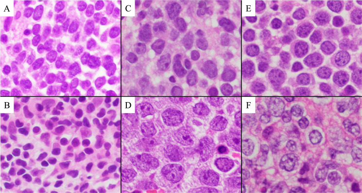 Hans's algorithm and MYD88<sup>L265P</sup> mutation may affect prognosis of primary central nervous system B-cell lymphoma.