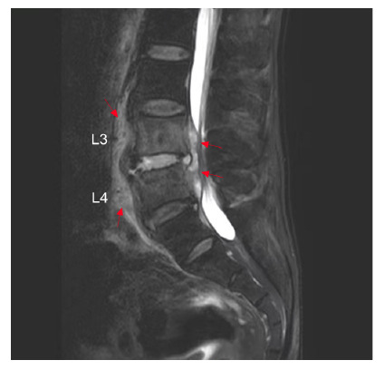 The appearances of a parrot's peak and petal rims in brucellar spondylitis.