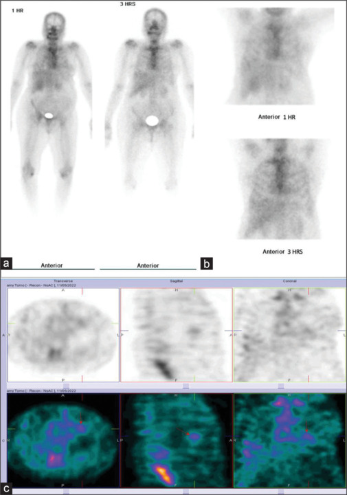 Assessment of ATTR Cardiac Amyloidosis in Patients with Left Ventricular Hypertrophy Using Tc-99m Pyrophosphate Scintigraphy.