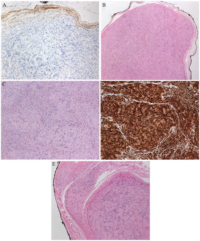 Clinical and Pathological Features of a Schwannoma Harboring a <i>SH3PXD2A::HTRA1</i> Gene Fusion in a Pre-pubescent Patient.