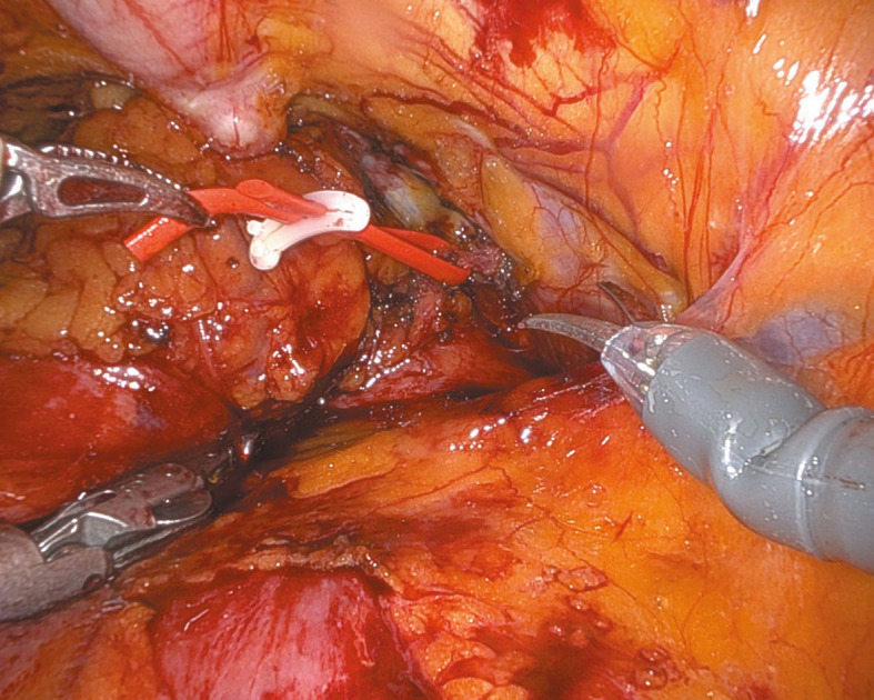 Robot‑assisted surgical management of mid‑urethral sling erosion into the bladder using transperitoneal robotic extensive approach for total mesh excision.