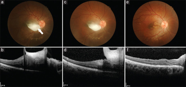 Retinal vascular proliferation with fibrotic regression in von Hippel-Lindau disease.