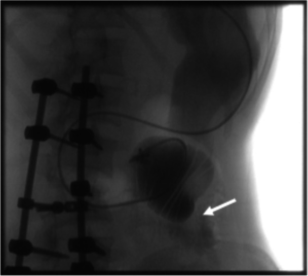 An indolent case of traumatic bowel injury as a superior mesenteric artery syndrome mimic.
