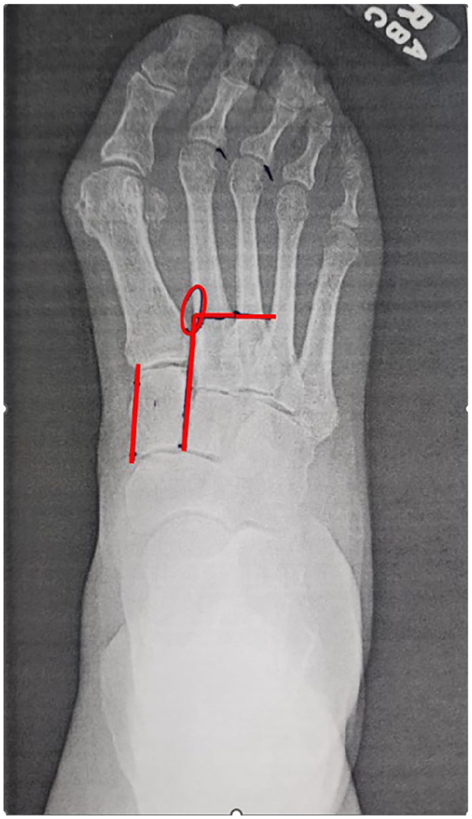 Approaches to Minimally Invasive Surgery for Treatment of Metatarsus Adductus with Hallux Valgus Correction With Modified Lapidus: A Novel Technique Guide.