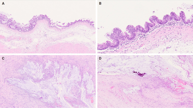 Mucocele of the rectal stump: mucinous cystic neoplasm with low-grade dysplasia simulating low-grade appendiceal mucinous neoplasm.
