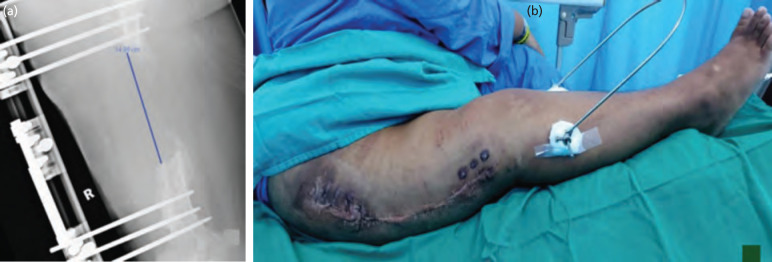 Chimeric Free Fibula Osteocutaneus Flap and Massive Allograft for Refractory Post-traumatic Osteomyelitis Femur Defect: A Case Report.