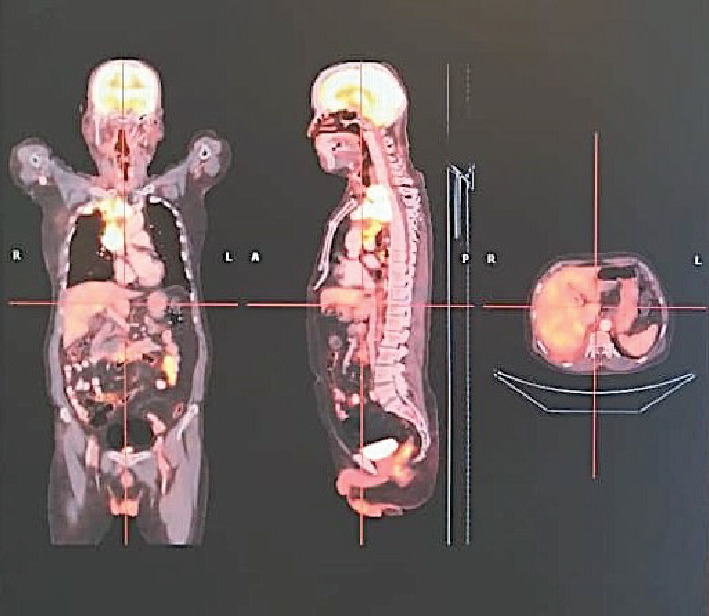 Sustained Remission With Atezolizumab in a Frail, Geriatric Patient With Advanced-Stage Large Cell Neuroendocrine Carcinoma Lung.
