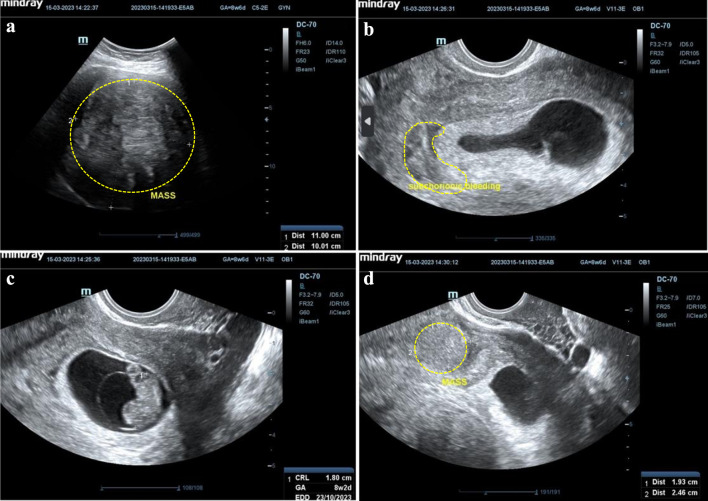 An Unusual and Successful Pregnancy With Multiple Large Uterine Fibroids Delivered by Cesarean Myomectomy.