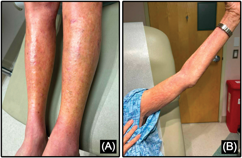 A Challenging Case of Eosinophilic Fasciitis Without Classic Histopathological Findings.