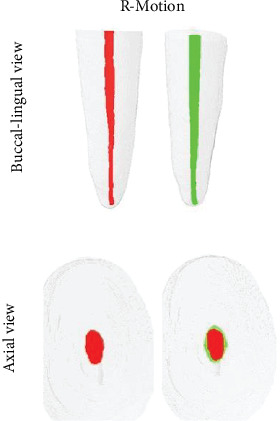 Shaping Ability of the ProTaper Gold and R-Motion Systems in Long-Oval Canals: A Microcomputed Tomography Study.