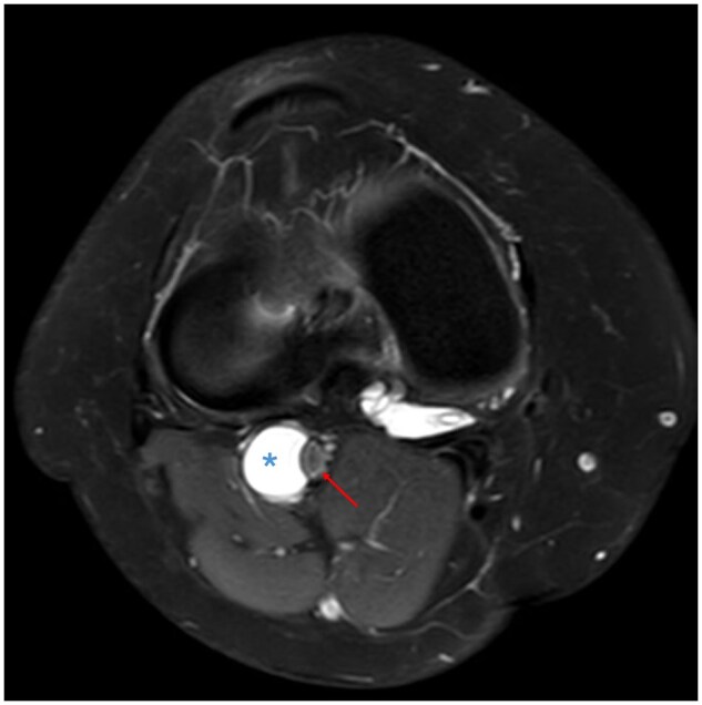 Meniscal tear of the knee causing cystic adventitial disease of popliteal artery: support for the synovial theory.