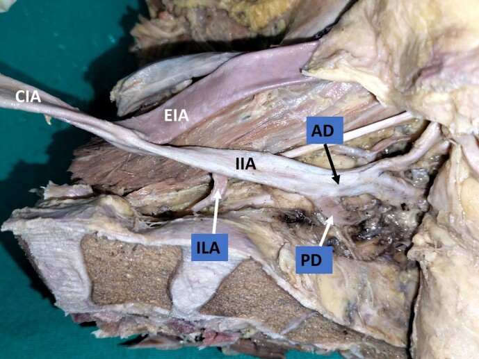Variations in the branching pattern of the internal iliac artery and its implications in trauma and surgery - a South Indian cadaveric study.