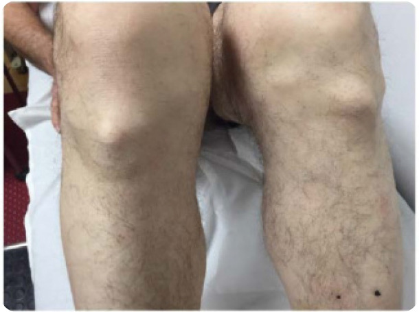 Diffuse Idiopathic Skeletal Hyperostosis, beyond the Axial Skeleton: Extra-spinal DISH.