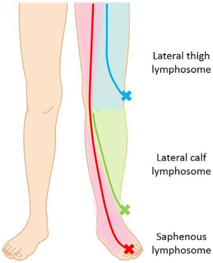Efficacy study of lymphaticovenular anastomosis via the lymphosome-based four-incision approach for lower limb lymphedema