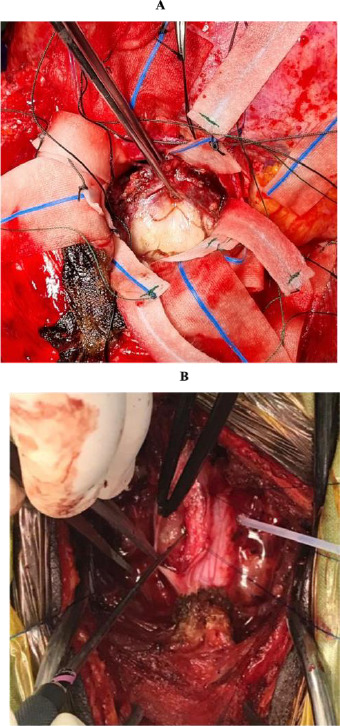 A retrospective single-centre study on the histological profile of brain and spine tumours at a tertiary hospital in Ghana.