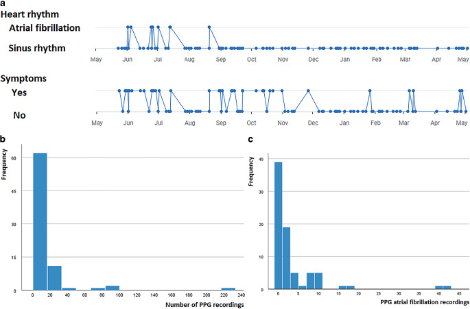Initial experience with a virtual atrial fibrillation clinic after pulmonary vein isolation using follow-up with photoplethysmography.