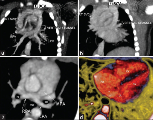 Pulmonary artery sling with total anomalous pulmonary venous return: Hitherto unreported association.