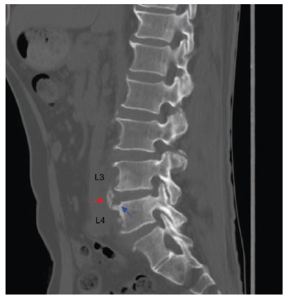 The appearances of a parrot's peak and petal rims in brucellar spondylitis.
