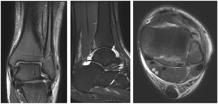 Ligamentous Injuries in Stable Ankle Fractures: An MRI-Based Study.