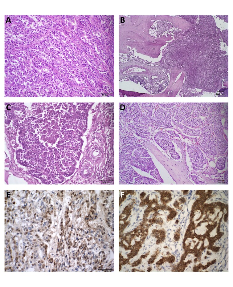 Histopathological, immunohistochemical and imaging features of bone metastases of mammary carcinoma in bitches: cases report.