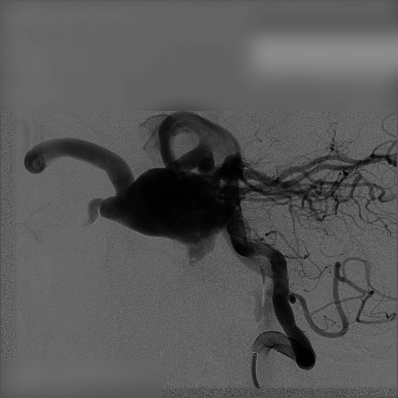Echoes of Trauma: DSA-Guided Coil Embolization for Carotid Cavernous Fistula Presenting with Ocular Bruit and Pulsatile Exophthalmos.