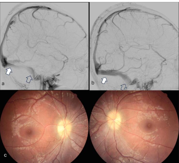 Idiopathic Intracranial Hypertension.