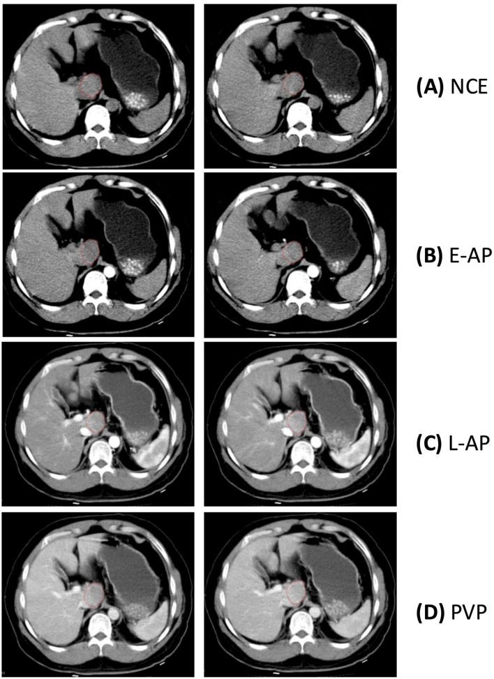 Variability of HCC Tumor Diameter and Density Measurements on Dynamic Contrast-Enhanced Computed Tomography.