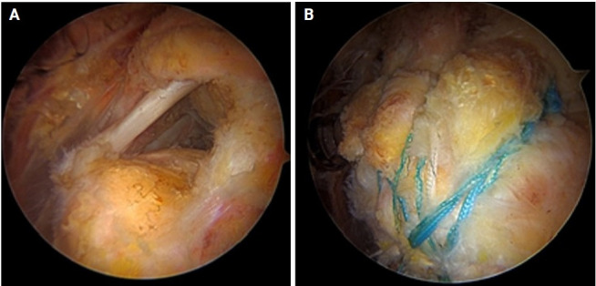 Rare complication of acute transient parotitis after arthroscopic rotator cuff repair: a case report.