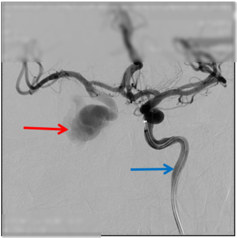 Echoes of Trauma: DSA-Guided Coil Embolization for Carotid Cavernous Fistula Presenting with Ocular Bruit and Pulsatile Exophthalmos.