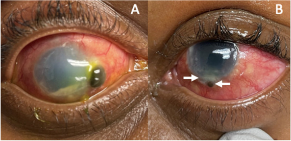 Rare bilateral corneoscleral perforation secondary to ocular tuberculosis: a case report and clinical insights.