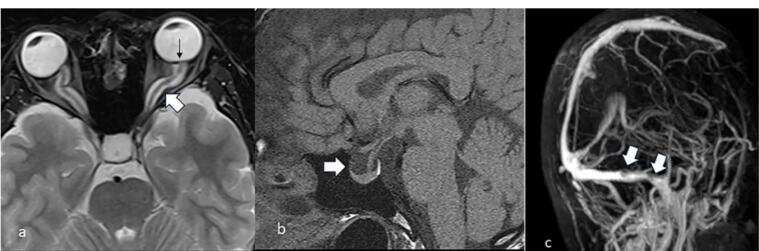 Idiopathic Intracranial Hypertension.