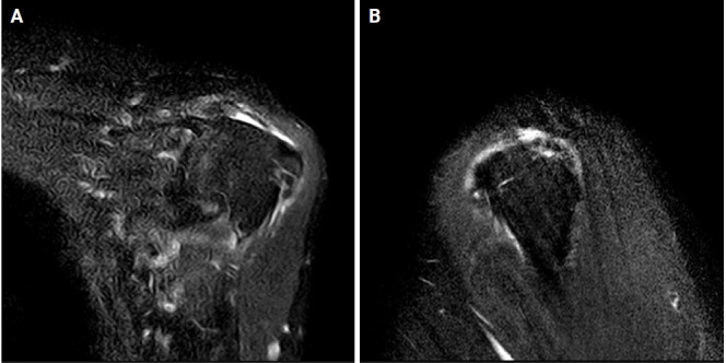 Rare complication of acute transient parotitis after arthroscopic rotator cuff repair: a case report.