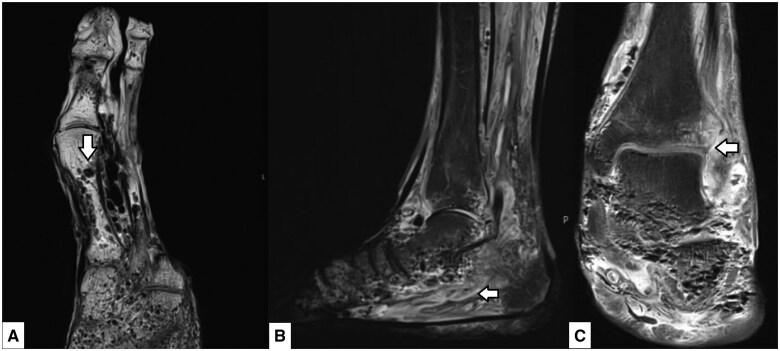 Soft tissue and intraosseous pneumatosis secondary to diabetic foot ulcer: a severe case of emphysematous osteomyelitis.